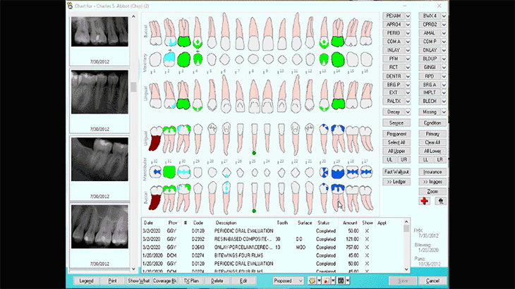 Animation showing the interactive tooth chart feature of Eaglesoft dental practice management software