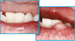 Before image of lesion on lip and after image of lip treated with laser