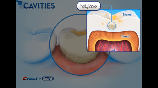 Image showing tooth decay