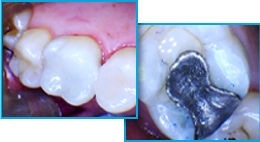 Before image of tooth with amalgam and decay and after image of tooth restored