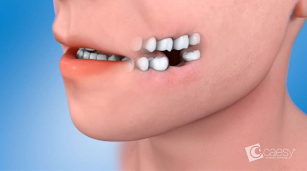 Image from an animation about tooth extraction