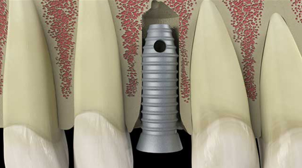 Image of a tooth implant