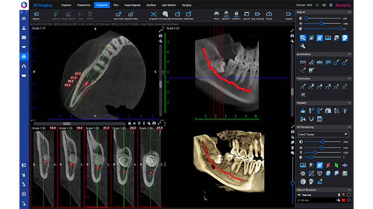 Image of a wisdom tooth from the Planmeca Romexis Implant Module